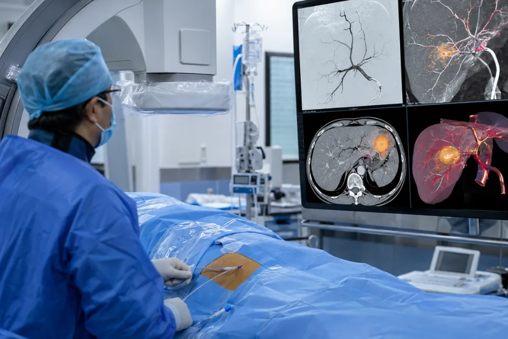Quimioembolización en Guatemala: terapia local que combina quimioterapia y bloqueo vascular